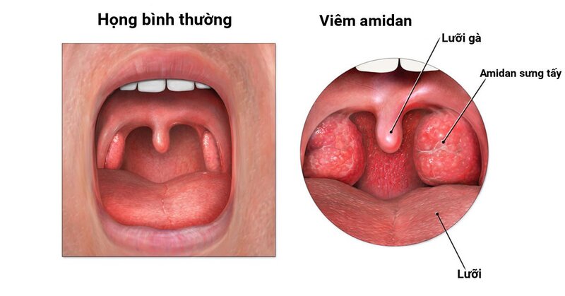 Đau họng uống thuốc gì