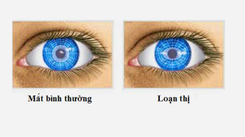 loạn thị là gì