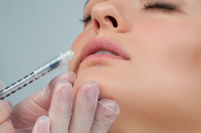 Tiêm filler môi