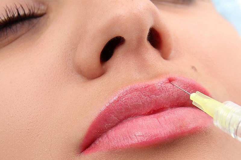 Tiêm filler môi
