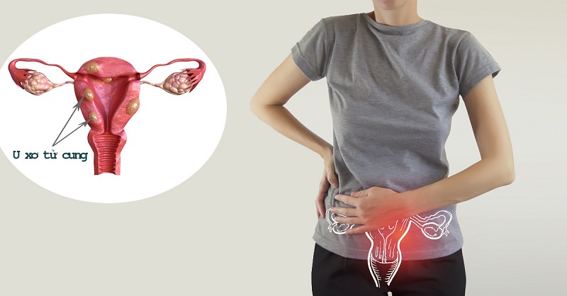 U xơ tử cung