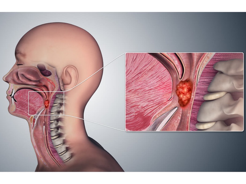 ung thư vòm họng