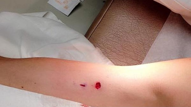 Cấy que tránh thai