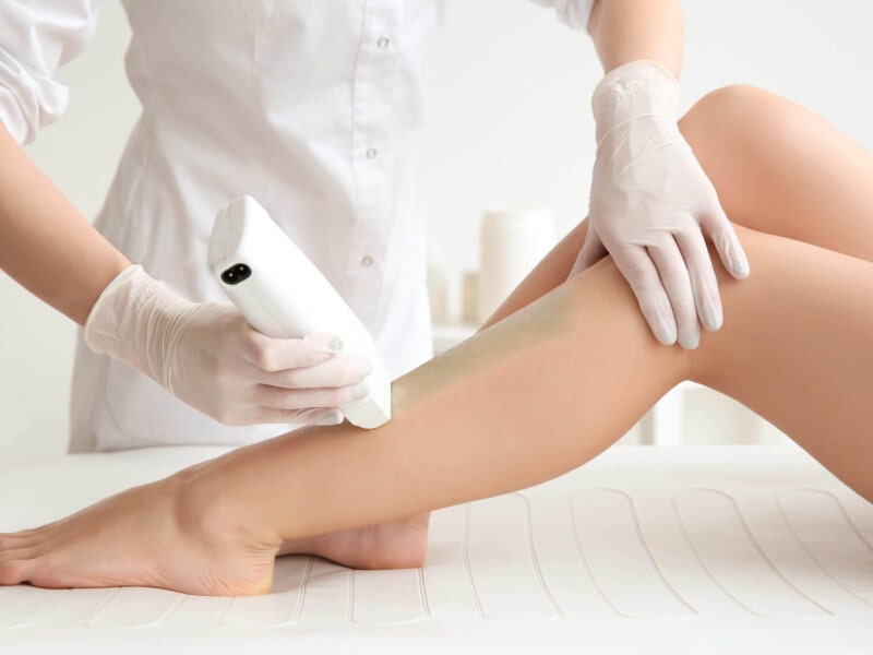 Triệt lông vĩnh viễn