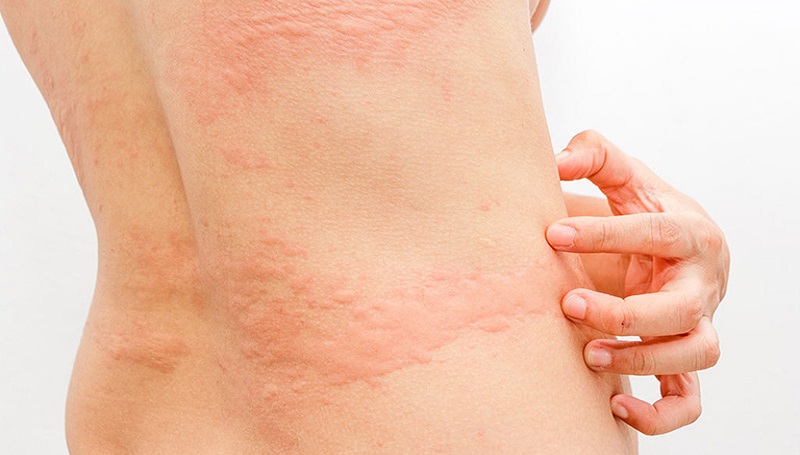 nổi mề đay kiêng gì