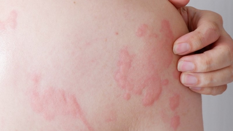 nổi mề đay kiêng gì