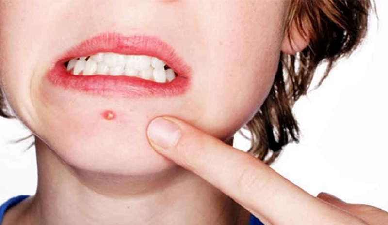 cách trị mụn nhọt