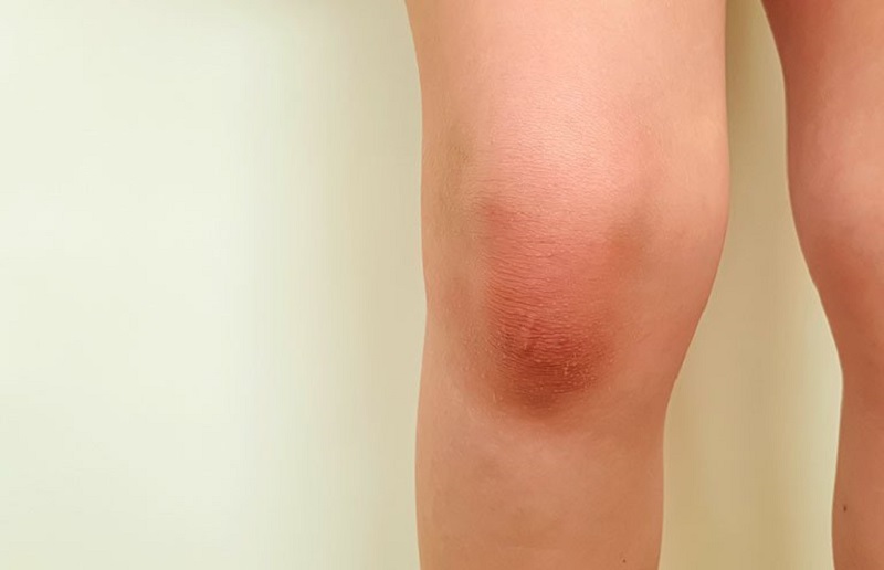 tràn dịch khớp gối