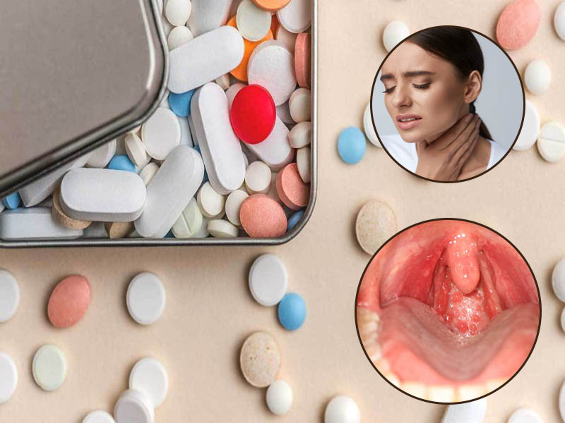 thuốc trị viêm họng hạt