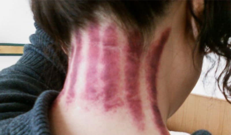 Cạo gió là phương pháp đơn giản nhưng mang đến hiệu quả tức thì