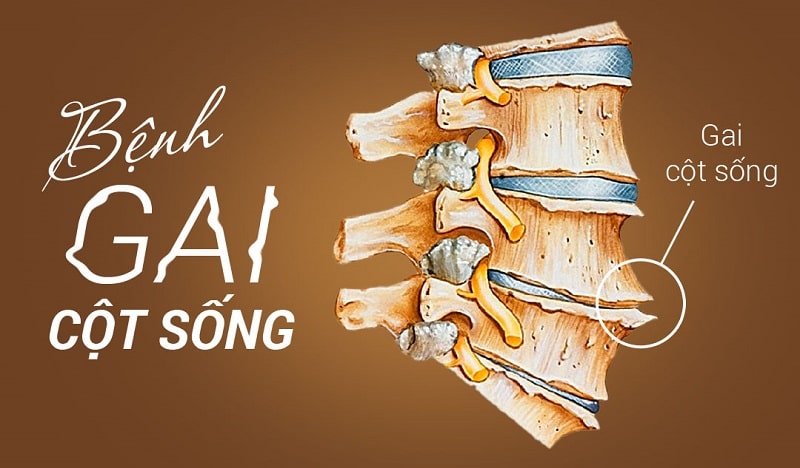 Bệnh lý gây ảnh hưởng đến sinh hoạt hàng ngày