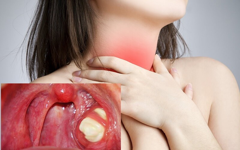 Viêm vọng là vùng niêm mạc họng bị tổn thương, bị sưng tấy, đỏ, đau rát và ngứa khó chịu