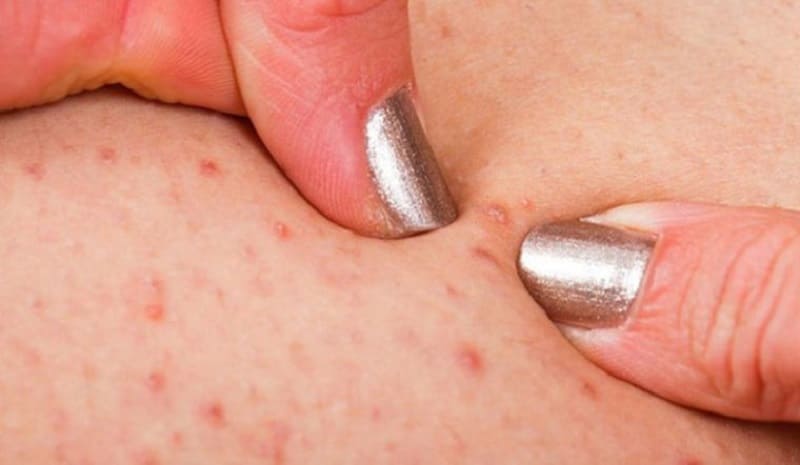 Bệnh viêm lỗ chân lông thường có triệu chứng khá phức tạp