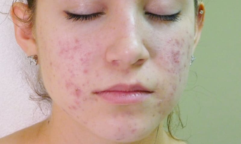 Thay đổi thói quen sinh hoạt giúp cải thiện bệnh