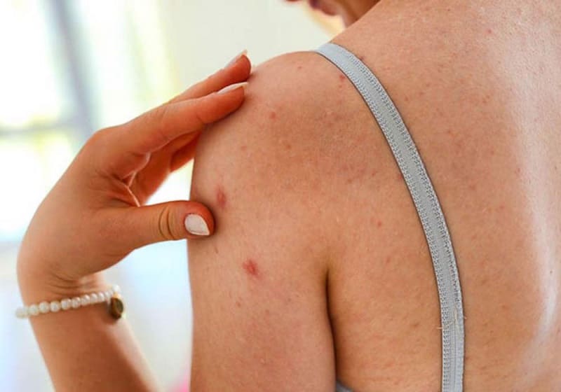 Cần áp dụng các biện pháp phòng tránh nhằm ngăn ngừa bệnh
