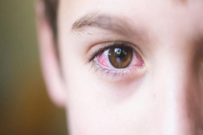 Đau mắt đỏ là mắt đang bị viêm nhiễm